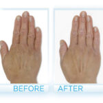 WEBSITE_HandRestore_BeforeAfter-500x429